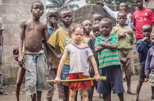 Goma : les enfants atteints d'albinisme victimes de stigmatisation et manque de protection dans les camps des déplacés 