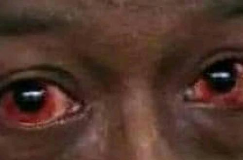 Ituri : des détenus atteints par la conjonctivite virale à la prison de Bunia
