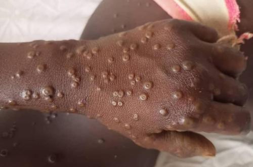 Des cas suspects de MPOX dans les camps de déplacés à Goma, MSF alerte