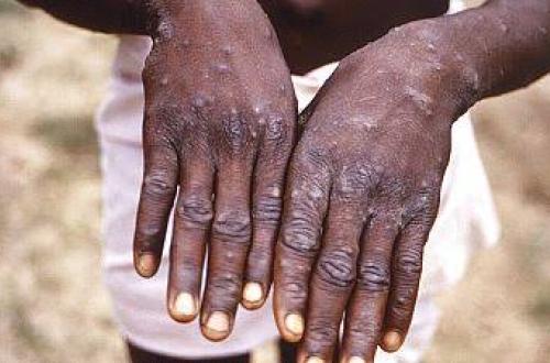 Nord-Kivu : vingt-sept nouveaux cas de MonkeyPox, les déplacés de guerre sont parmi les plus touchés