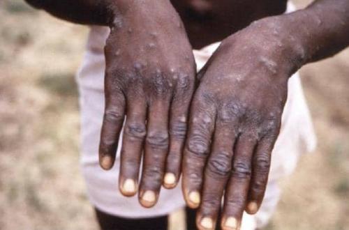 Six cas suspects de la Mpox notifiés en Ituri