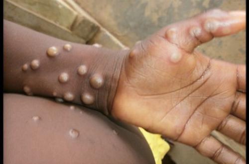 Cas suspect de variole du singe ou Monkeypox sont notifiés en province de l’Ituri