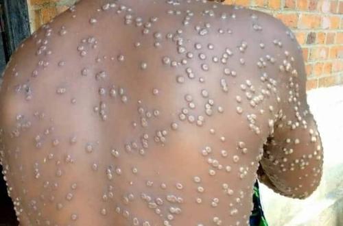 Riposte contre le Monkeypox, La RDC s'apprête à débloquer un montant de 49 millions de dollars américains