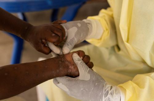 Variole du singe à Mbandaka, 72 malades guéris