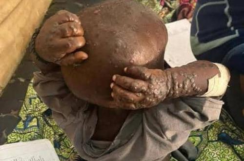 Un cas confirmé de Mpox détecté dans la zone de santé d’Oïcha