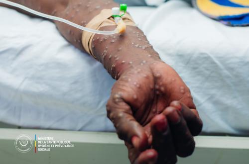Progrès dans la lutte contre le Mpox en RDC, bilan et perspectives pour 2025 présenté par le ministère de la Santé