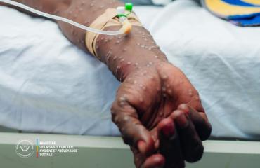 RDC : recul du choléra et légère baisse du M-pox