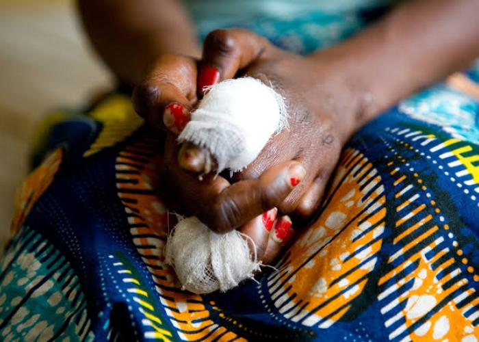 Journée Mondiale de la lèpre : la situation épidémiologique reste instable au Nord-Kivu