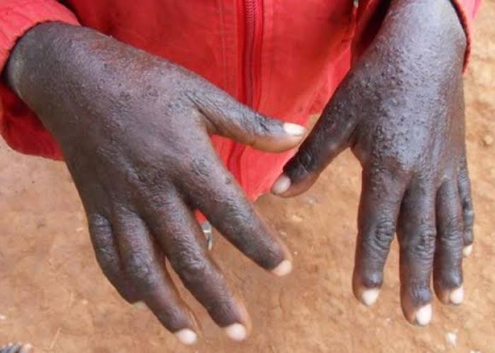 Nyiragongo : les déplacés de guerre frappés par la gale SHISHIKARA