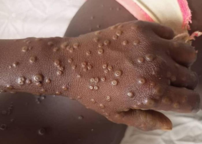 Des cas suspects de MPOX dans les camps de déplacés à Goma, MSF alerte