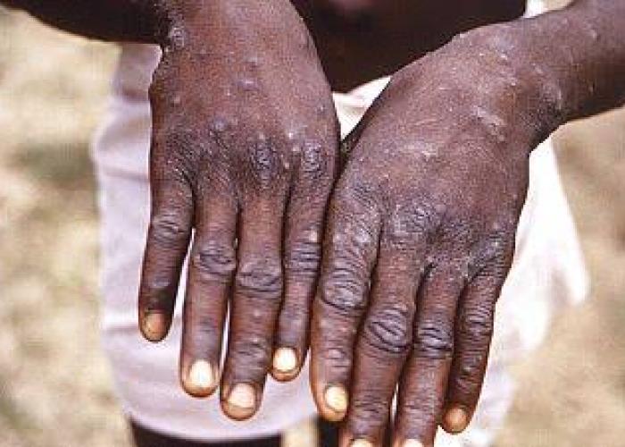 Nord-Kivu : vingt-sept nouveaux cas de MonkeyPox, les déplacés de guerre sont parmi les plus touchés