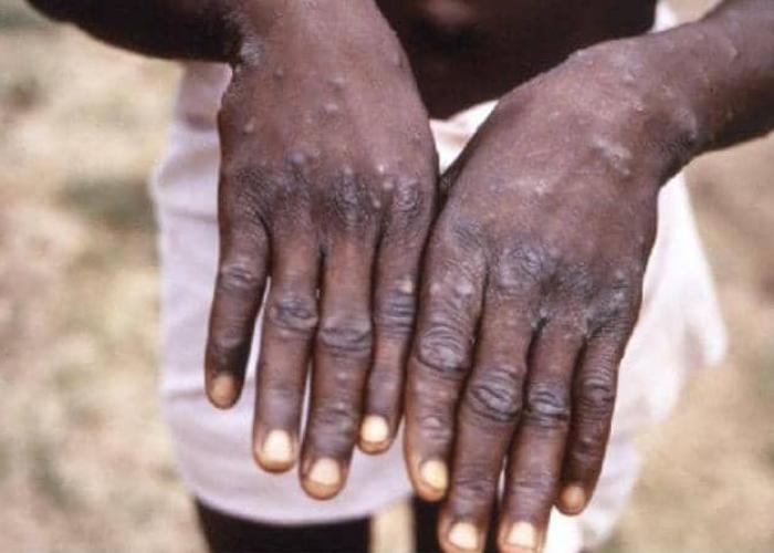 Six cas suspects de la Mpox notifiés en Ituri