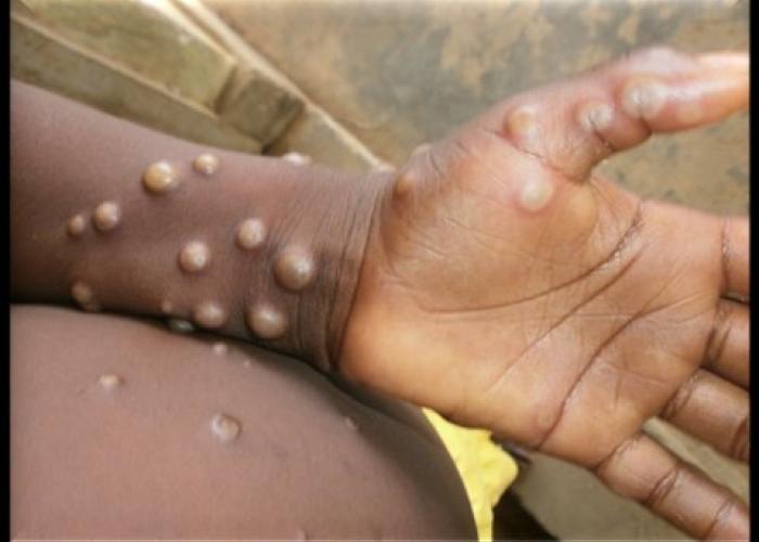Cas suspect de variole du singe ou Monkeypox sont notifiés en province de l’Ituri