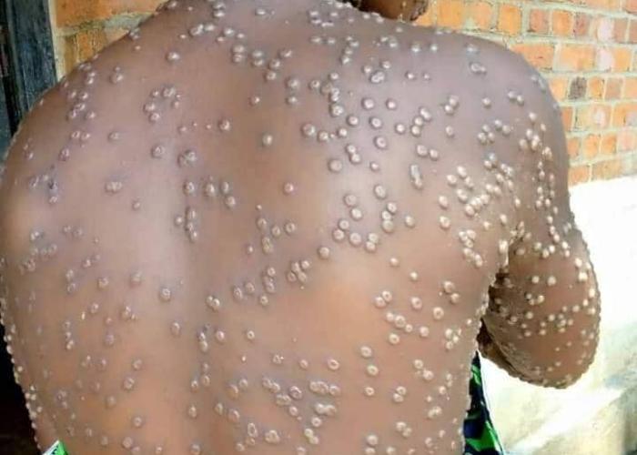 Riposte contre le Monkeypox, La RDC s'apprête à débloquer un montant de 49 millions de dollars américains