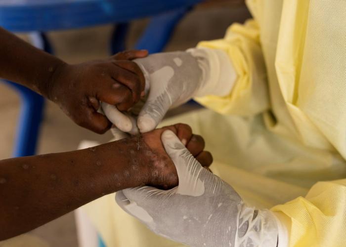 Variole du singe à Mbandaka, 72 malades guéris