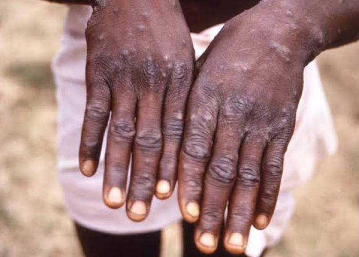 Une maladie apparente à la Mpox déclarée dans l'EGEE/Beni