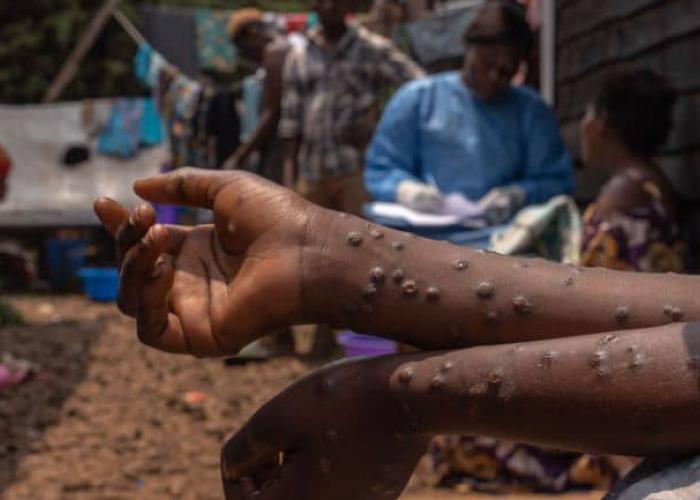 La vaccination des contacts se poursuit en zones de santé de Beni et Mutwanga