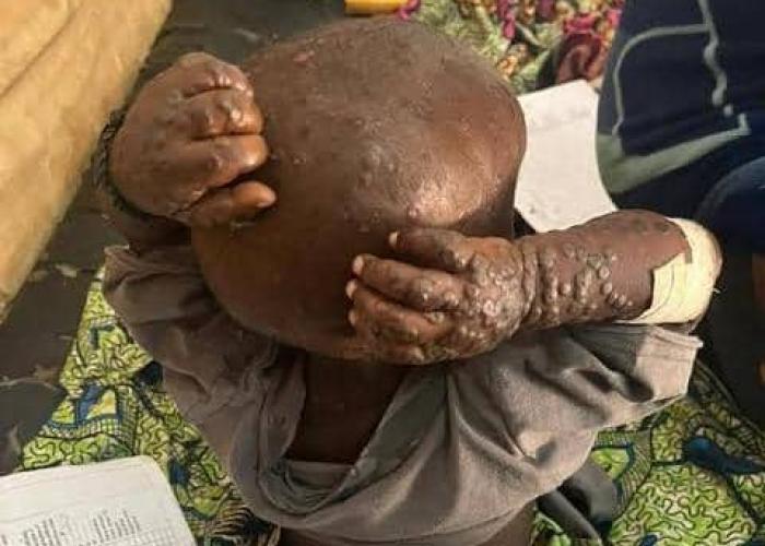 Un cas confirmé de Mpox détecté dans la zone de santé d’Oïcha