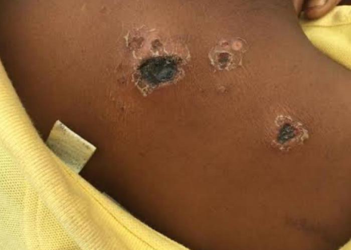 Alerte sanitaire maximale Face à la menace de l'Anthrax dans trois zones de santé