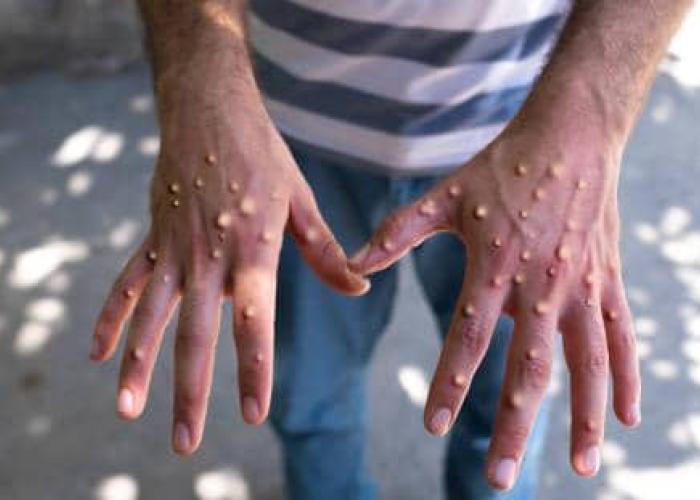 Un cas de Mpox confirmé à Lomé : le gouvernement Togolais appelle à la vigilance